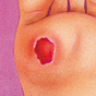 Diabetic Ulcer / Ulcers